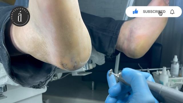 Трещины на пятках | Cracked heels. #pedicure #podologia смотреть онлайн