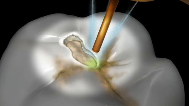 BIOLASE WaterLase vs Cross Contamination смотреть онлайн