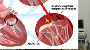 Пролапс митрального клапана. Что это и как быть.