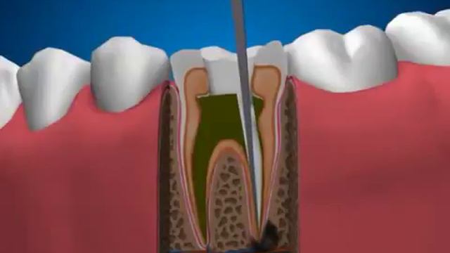Периодонтит зуба и его лечение смотреть онлайн