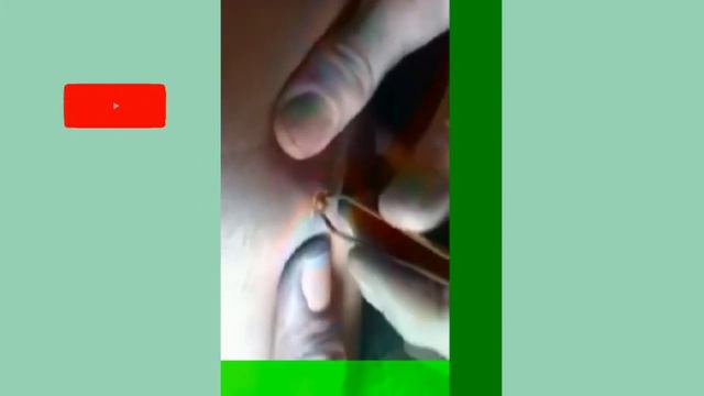 Новое выдавливание ПРЫЩЕЙ и ЧЕРНЫХ ТОЧЕК! Blackheads- Acne(Part 107) смотреть онлайн