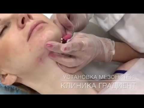 ТРЕДЛИФТИНГ МЕЗОНИТЯМИ - БИОАРМИРОВАНИЕ смотреть онлайн