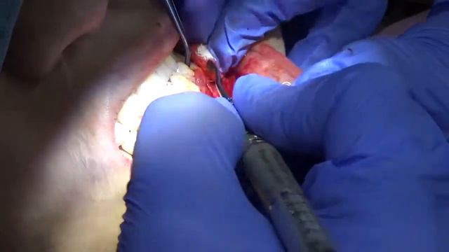 Вестибулопластитка с  коронально перемещенным лоскутом