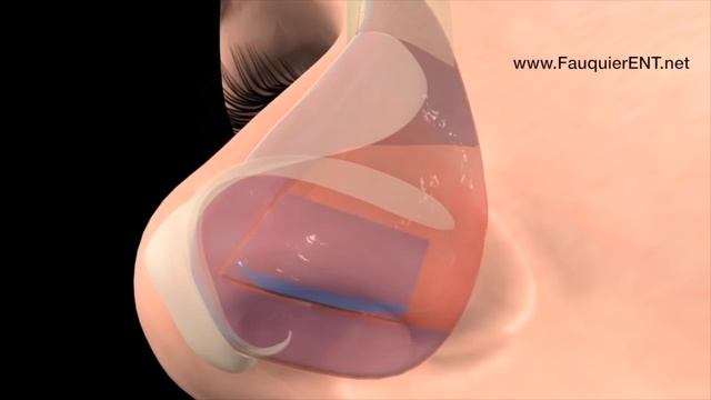 Deviated Septum Surgery (Septoplasty)