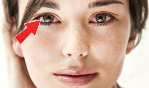 Почему чешутся глаза? Чешутся глаза что делать? Причины по которым могут чесаться глаза!