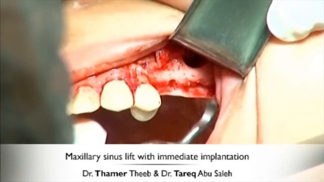 Maxillary Sinus Lifting With Immediate Implantation смотреть онлайн