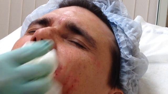 Аириском студенты учатся: заполнение морщин филлером и биоревитализация мужчина 37 лет. смотреть онлайн