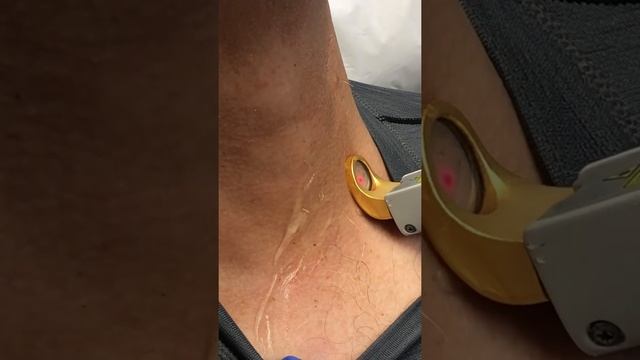 excel V Laser Genesis for cherry angiomas - Cynthia Golomb, MD смотреть онлайн