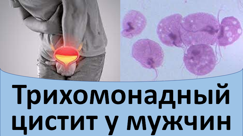 Трихомонадный цистит у мужчины смотреть онлайн