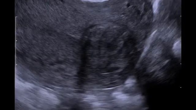 Миома матки смотреть онлайн