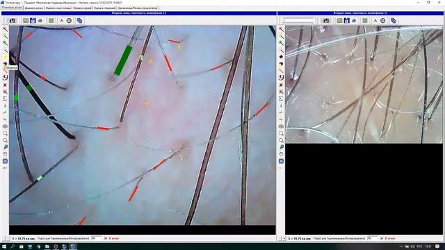 3 видео:Программа Trichoscience, раздел Трихоскопия (проведение диагностики)