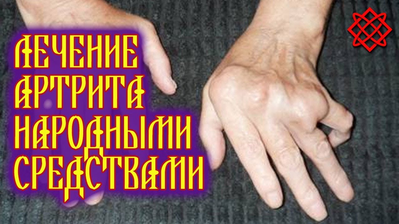 АРТРИТ СИМПТОМЫ И ЛЕЧЕНИЕ НАРОДНЫМИ СРЕДСТВАМИ. Как Вылечить Артрит без Врачей и Таблеток.mp4