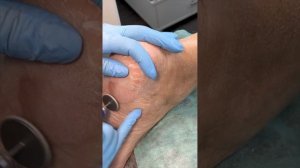 Обработка пяток и трещин. Смарт педикюр