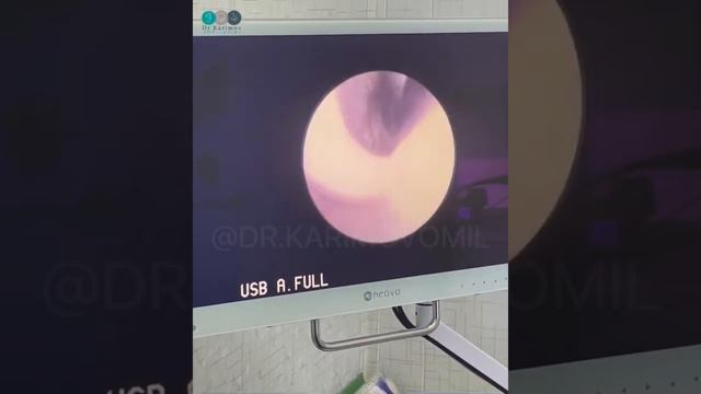 Septoplastika amaliyoti смотреть онлайн