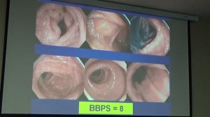 02 Иванова ЕВ Первый опыт применения Эзиклен в подготовке к стандартной и капсульной эндоскопии