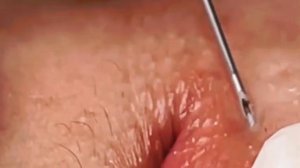 ✅ Чистка пор и Выдавливание прыщей #16