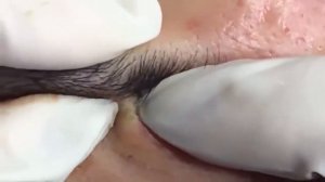 Прищи на лице удаляем