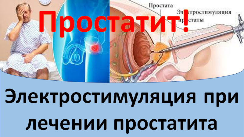 Электростимуляция при лечении простатита смотреть онлайн