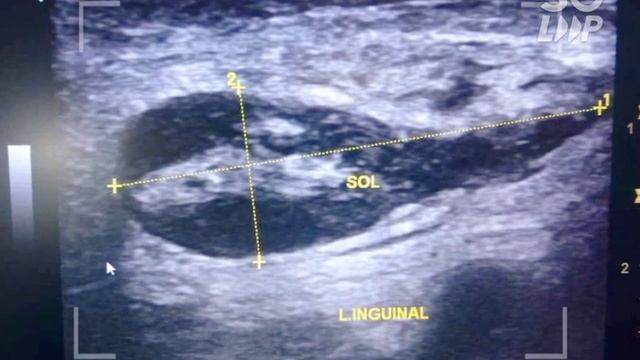 inguinal lesion смотреть онлайн