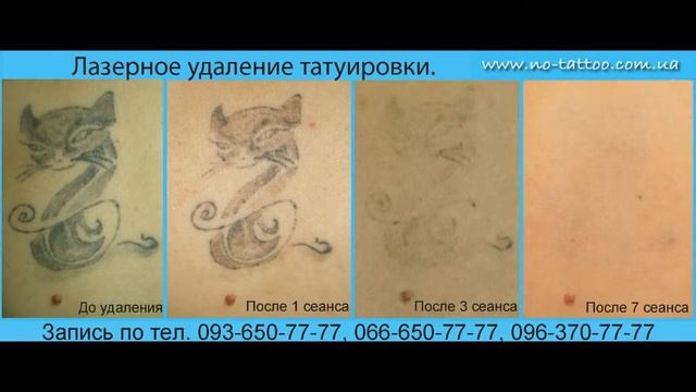 УДАЛЕНИЕ ТАТУИРОВОК И ТАТУАЖА ЛАЗЕРОМ КИЕВ смотреть онлайн