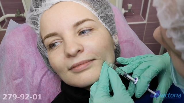 Особенности коррекции поверхностных носогубных складок филлером Juvederm Volift Ювидерм Волифт