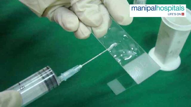 Fine Needle Aspiration Cytology (FNAC) test | Dr. Charu Aggarwal | Manipal Hospital Ghaziabad смотреть онлайн