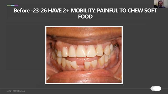 Airway Chat #18 with Dr. Ben Miraglia: Perio Improvements with Expansion (Clear Aligners) смотреть онлайн