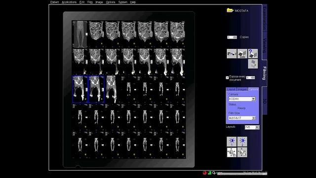 ct scan of lower limb angiogram filming смотреть онлайн