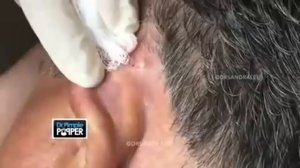 Красиво выдавил прыщ/Squeezing big pimple