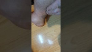 перелом пятой плюсневой кости стопы,лечим ногу
