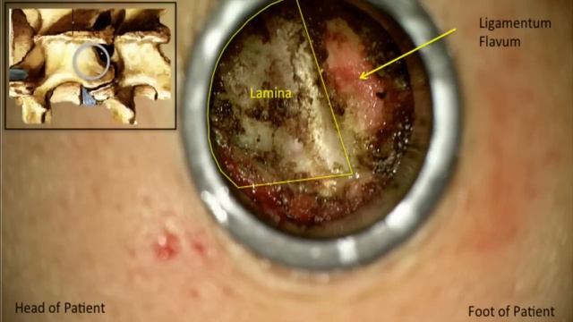 Minimally Invasive Microdiscectomy L5-S1 смотреть онлайн