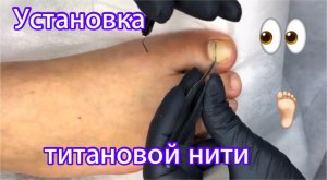 Установка титановой нити ???