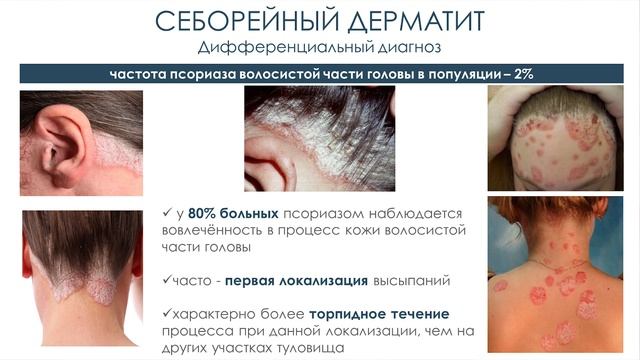 М. М. Юдина. «Тяжелая форма перхоти: современные аспекты диагностики и профилактики». смотреть онлайн