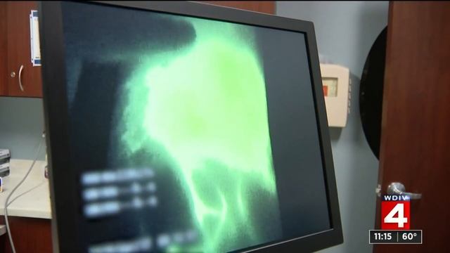 Lymph node transplants help some breast cancer survivors смотреть онлайн