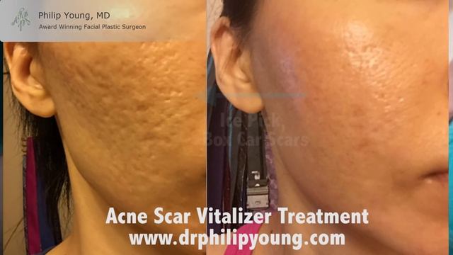 Treat All Types of Acne Scars in One Treatment in 2 Hours with the New Acne Scar Vitalizer Treatmen смотреть онлайн