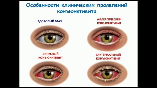 Конъюнктивит смотреть онлайн