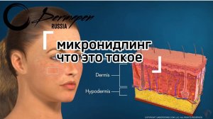 Микронидлинг или фракционная терапия, или процедура с аппаратом дермапен.