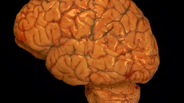 Language centers of the Brain - Adventures in Neuropathology смотреть онлайн