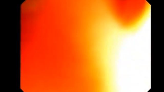 Полип ободочной кишки на длинной ножке смотреть онлайн