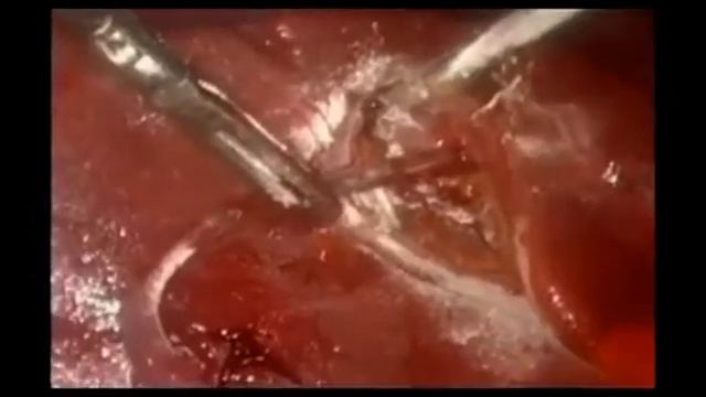 Гемостатик "сургитамп пудра" смотреть онлайн