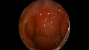 Недоразвитие сошника, расщелина мягкого неба.mp4