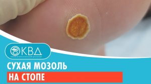 ? Сухая мозоль на стопе. Клинический случай №278