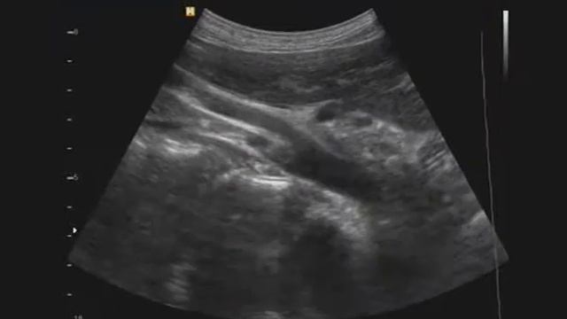 Локализация истоков почечных артерий относителельно верхней брыжеечной артерии смотреть онлайн