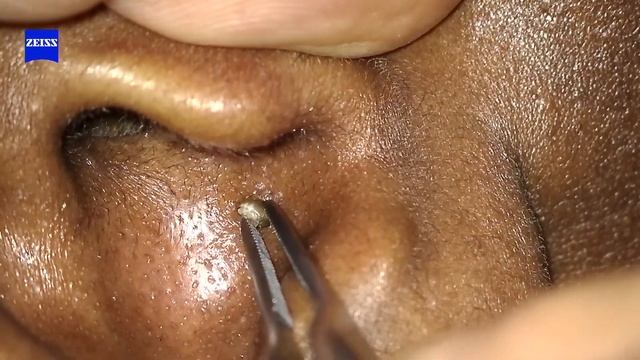 Large Blackhead Removed From The Ear | Dr Cameron McIntosh