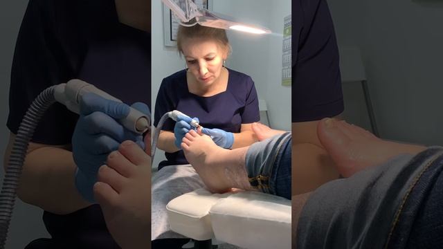 Лечение грибка ногтей - Подолог