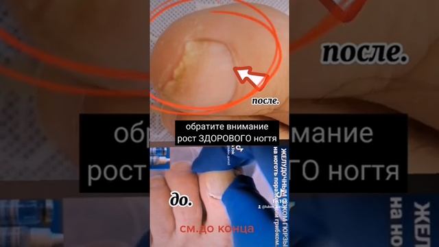 -Избавление от грибка ногтей ног смотреть онлайн