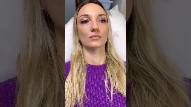 Контурная пластика губ в технике плоский бант ? #косметологмосква увеличениегубмосква смотреть онлайн