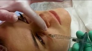 Коррекция носослезной борозды, филлер Франция, 7500р.