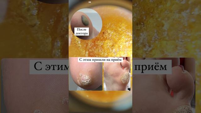Бородавки на стопе / бородавки у ребенка / бородавки смотреть онлайн