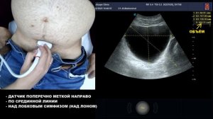 УЗИ мочевого пузыря. Порядок выполнения.